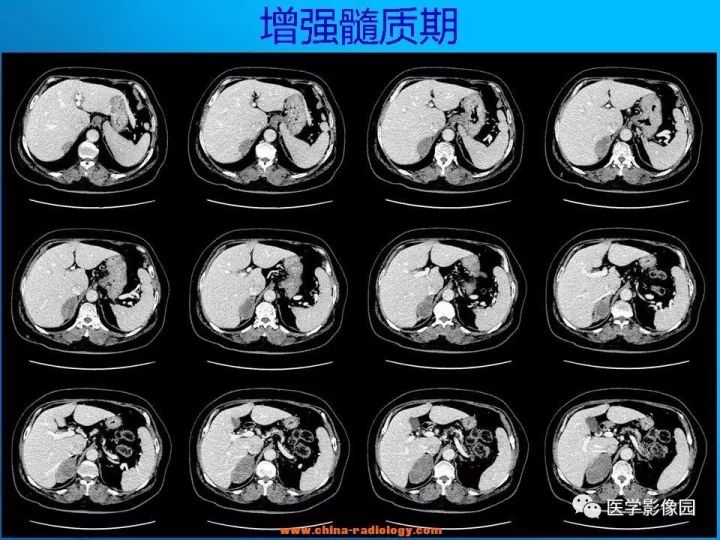【病例】肾上腺神经节细胞瘤1例CT及MR 【病例】肾上腺神经节细胞瘤1例CT及MR