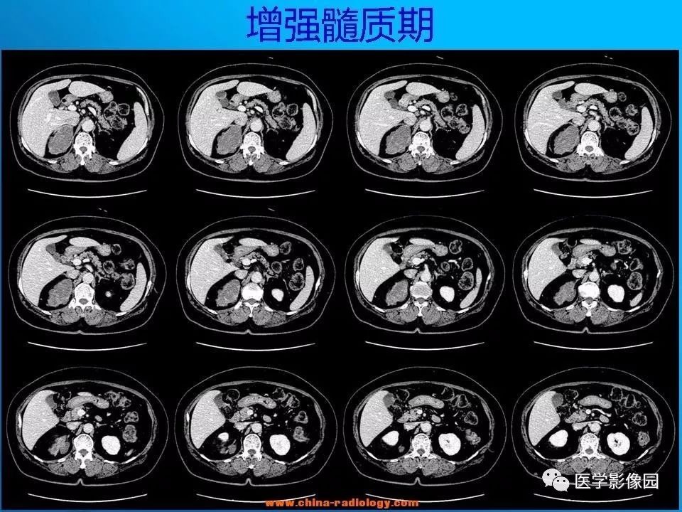 【病例】肾上腺神经节细胞瘤1例CT及MR 【病例】肾上腺神经节细胞瘤1例CT及MR