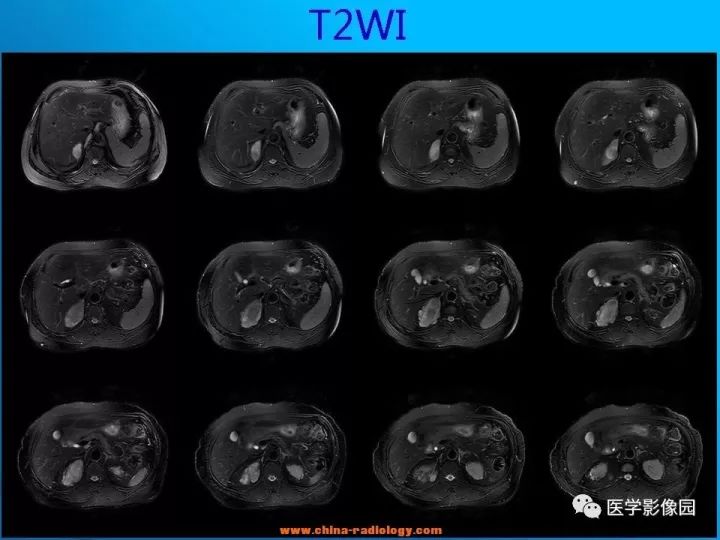 【病例】肾上腺神经节细胞瘤1例CT及MR 【病例】肾上腺神经节细胞瘤1例CT及MR