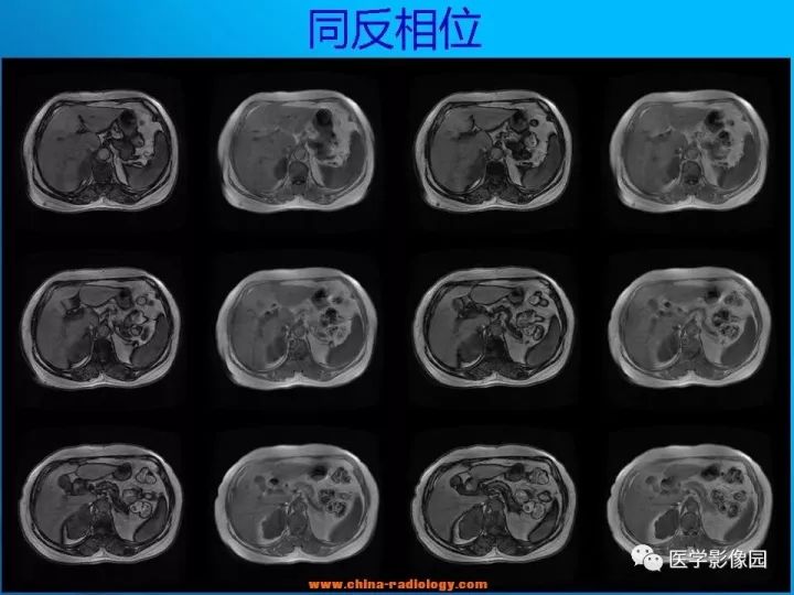 【病例】肾上腺神经节细胞瘤1例CT及MR 【病例】肾上腺神经节细胞瘤1例CT及MR