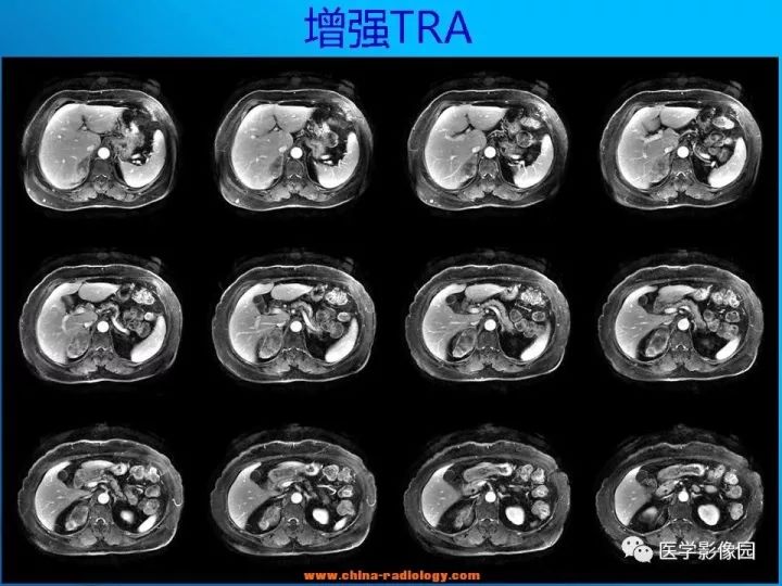 【病例】肾上腺神经节细胞瘤1例CT及MR 【病例】肾上腺神经节细胞瘤1例CT及MR