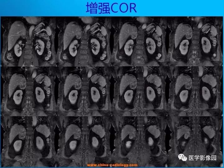 【病例】肾上腺神经节细胞瘤1例CT及MR 【病例】肾上腺神经节细胞瘤1例CT及MR