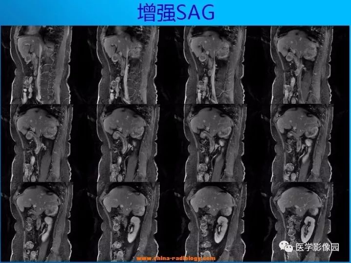 【病例】肾上腺神经节细胞瘤1例CT及MR 【病例】肾上腺神经节细胞瘤1例CT及MR