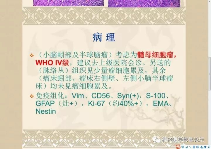 【病例】小脑蚓部髓母细胞瘤一例CT及MR