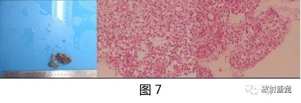 【病例】小脑蚓部毛细胞型星形细胞瘤1例MR 【病例】小脑蚓部毛细胞型星形细胞瘤1例MR