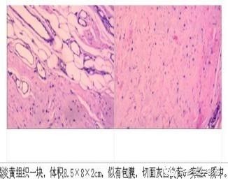 会让您过目不忘的背部弹力纤维瘤,你了解吗? 会让您过目不忘的背部弹力纤维瘤,你了解吗?
