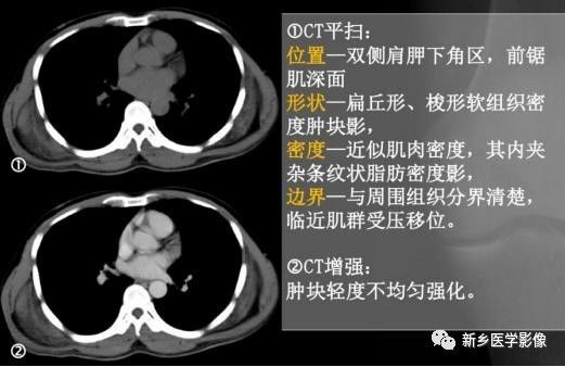 会让您过目不忘的背部弹力纤维瘤,你了解吗? 会让您过目不忘的背部弹力纤维瘤,你了解吗?