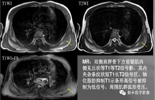 会让您过目不忘的背部弹力纤维瘤,你了解吗? 会让您过目不忘的背部弹力纤维瘤,你了解吗?