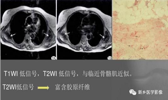 会让您过目不忘的背部弹力纤维瘤,你了解吗? 会让您过目不忘的背部弹力纤维瘤,你了解吗?