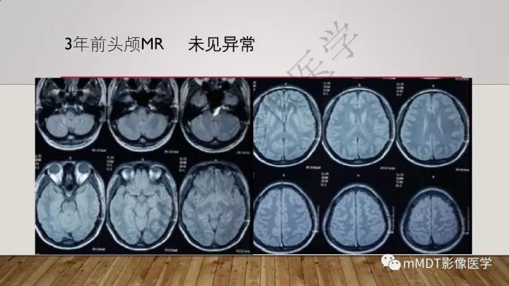 【病例】肾上腺脊髓神经病1例MR