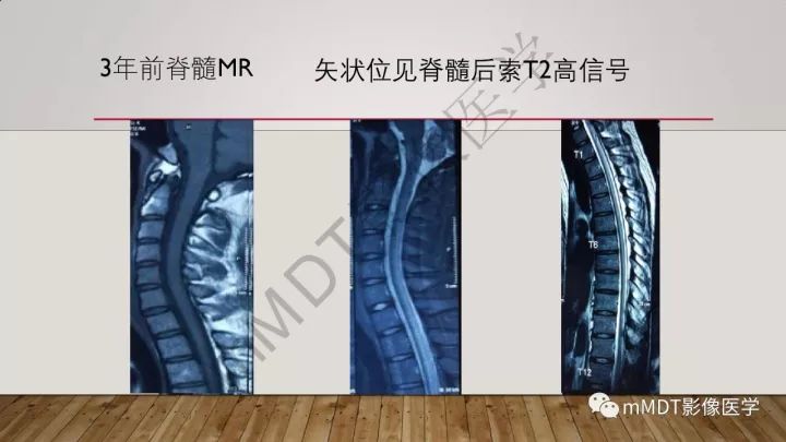 【病例】肾上腺脊髓神经病1例MR