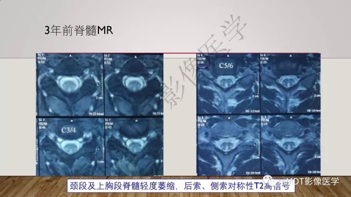 【病例】肾上腺脊髓神经病1例MR