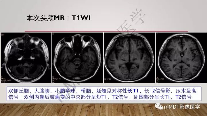 【病例】肾上腺脊髓神经病1例MR