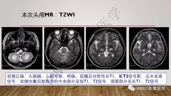 【病例】肾上腺脊髓神经病1例MR