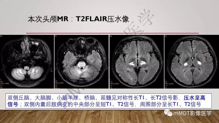 【病例】肾上腺脊髓神经病1例MR