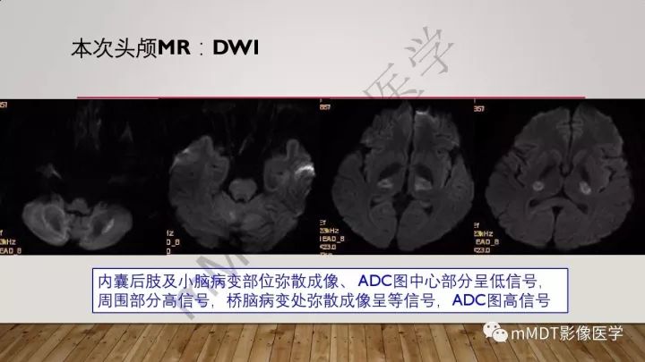 【病例】肾上腺脊髓神经病1例MR
