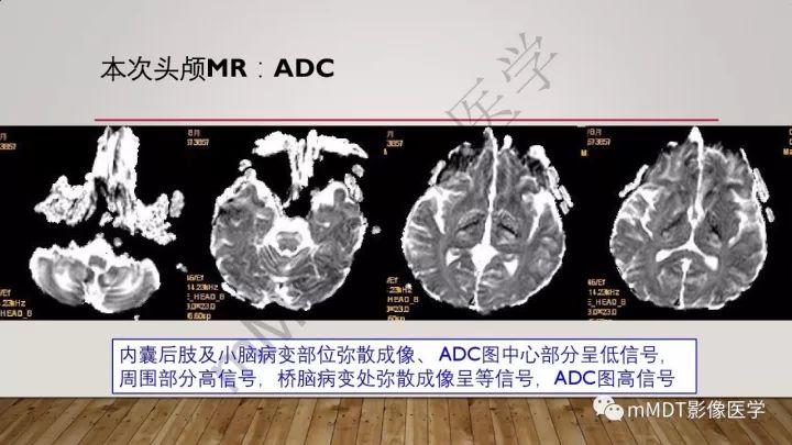 【病例】肾上腺脊髓神经病1例MR