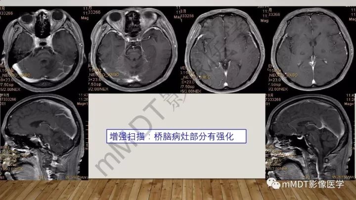 【病例】肾上腺脊髓神经病1例MR