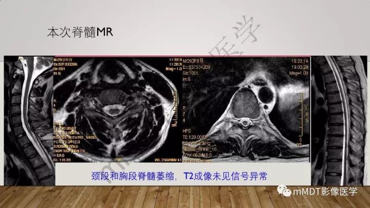 【病例】肾上腺脊髓神经病1例MR