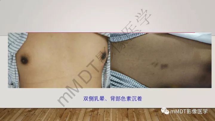 【病例】肾上腺脊髓神经病1例MR