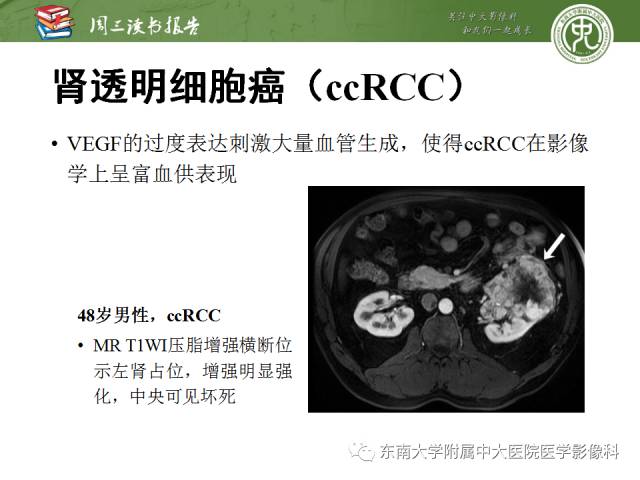 【PPT】晚期肾细胞癌：影像医生在精准医学时代中的作用