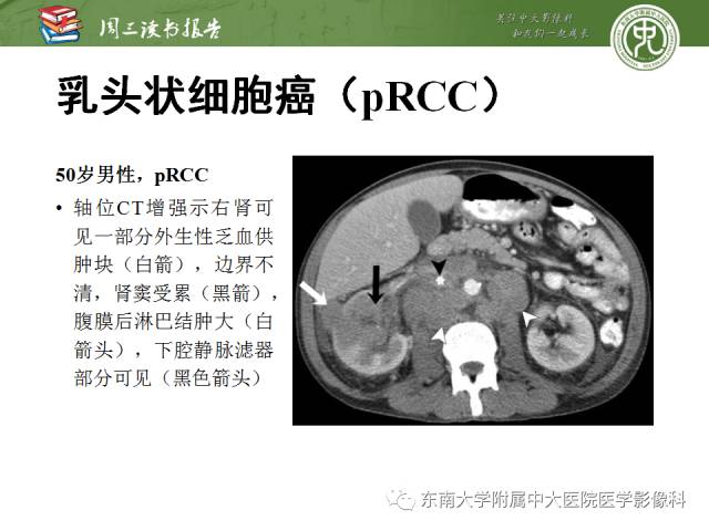 【PPT】晚期肾细胞癌：影像医生在精准医学时代中的作用