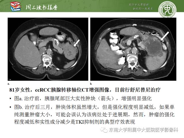【PPT】晚期肾细胞癌：影像医生在精准医学时代中的作用
