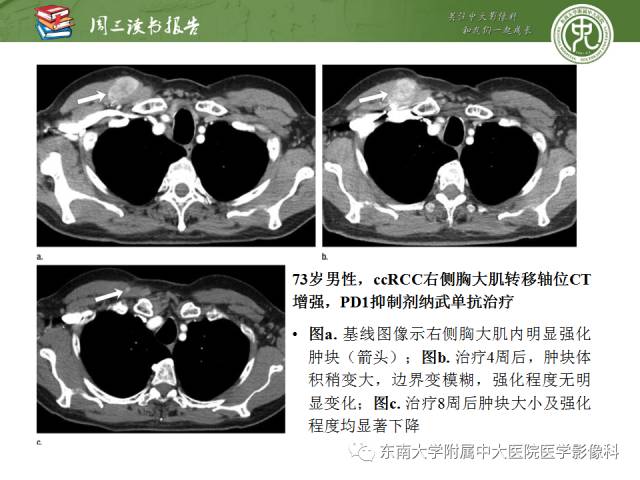 【PPT】晚期肾细胞癌：影像医生在精准医学时代中的作用