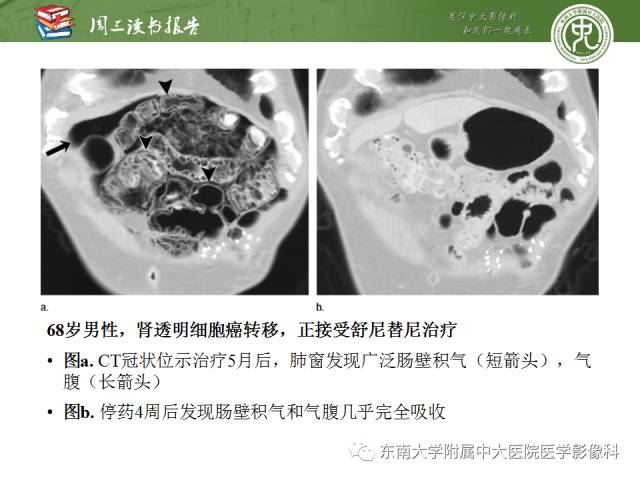【PPT】晚期肾细胞癌：影像医生在精准医学时代中的作用