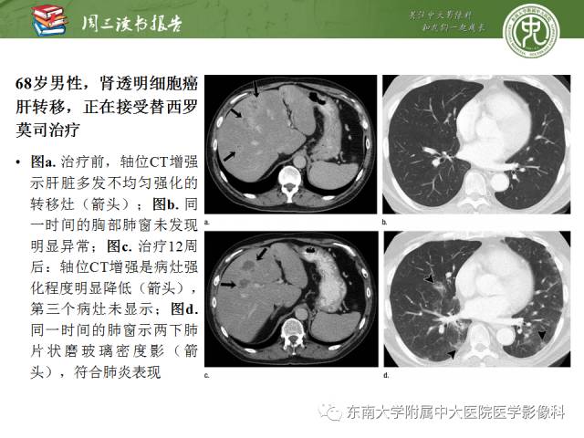 【PPT】晚期肾细胞癌：影像医生在精准医学时代中的作用
