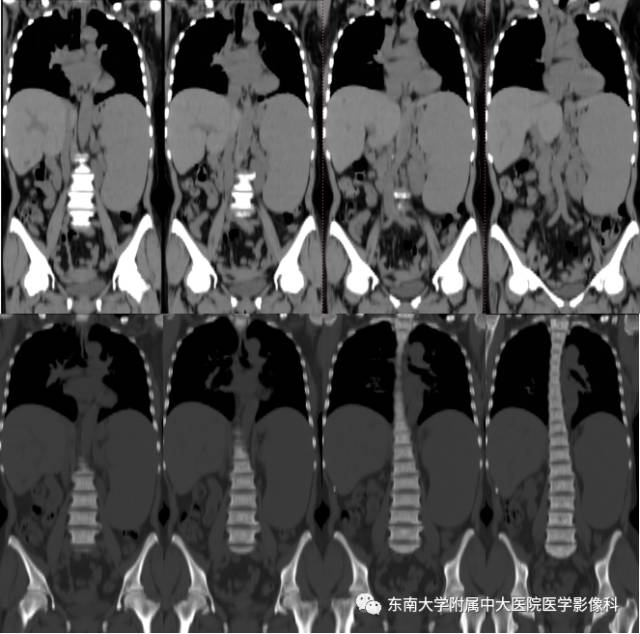 【病例】骨髓纤维化1例CT