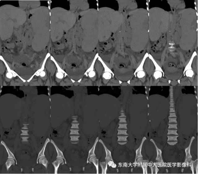 【病例】骨髓纤维化1例CT 【病例】骨髓纤维化1例CT