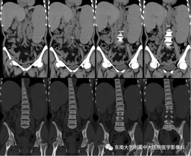【病例】骨髓纤维化1例CT 【病例】骨髓纤维化1例CT