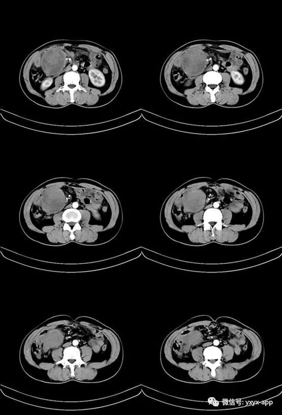 【病例】恶性小肠间质瘤肝转移1例CT 【病例】恶性小肠间质瘤肝转移1例CT