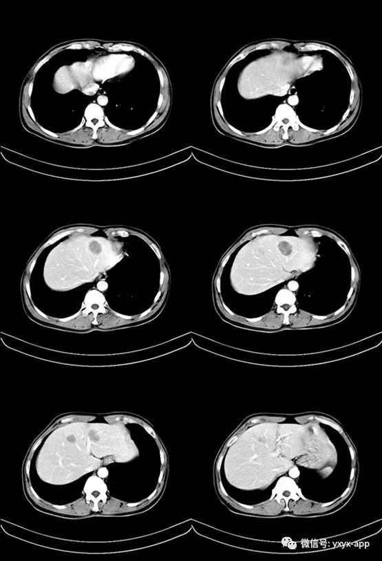 【病例】恶性小肠间质瘤肝转移1例CT 【病例】恶性小肠间质瘤肝转移1例CT