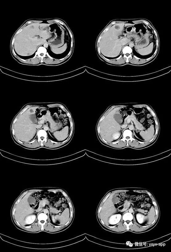 【病例】恶性小肠间质瘤肝转移1例CT 【病例】恶性小肠间质瘤肝转移1例CT
