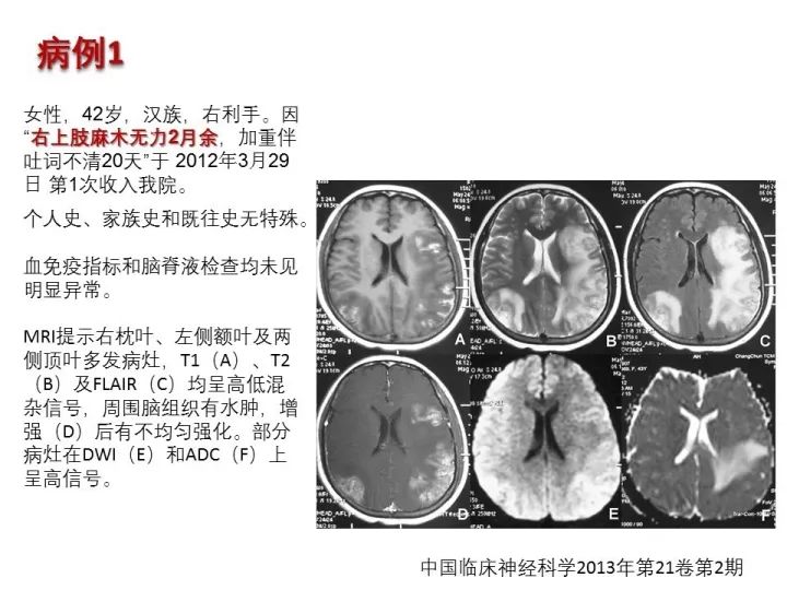 【PPT】中枢神经系统血管炎的临床思考
