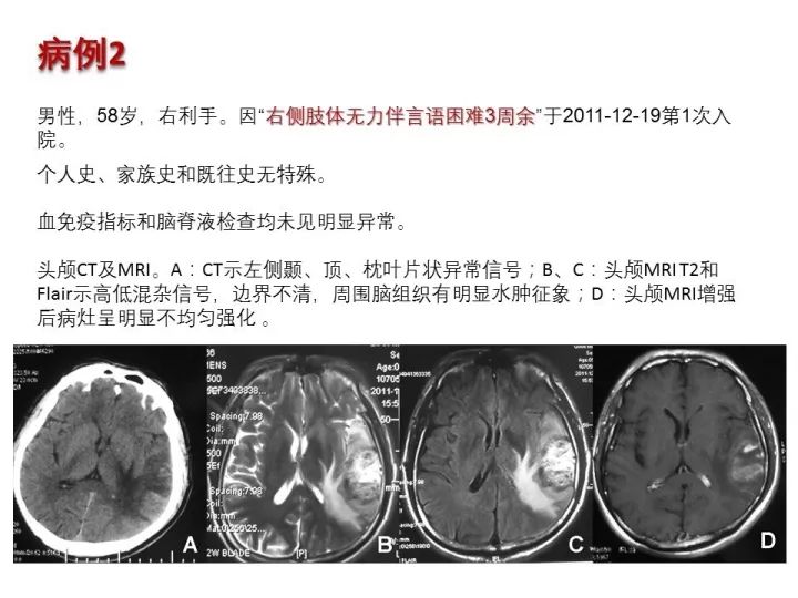 【PPT】中枢神经系统血管炎的临床思考