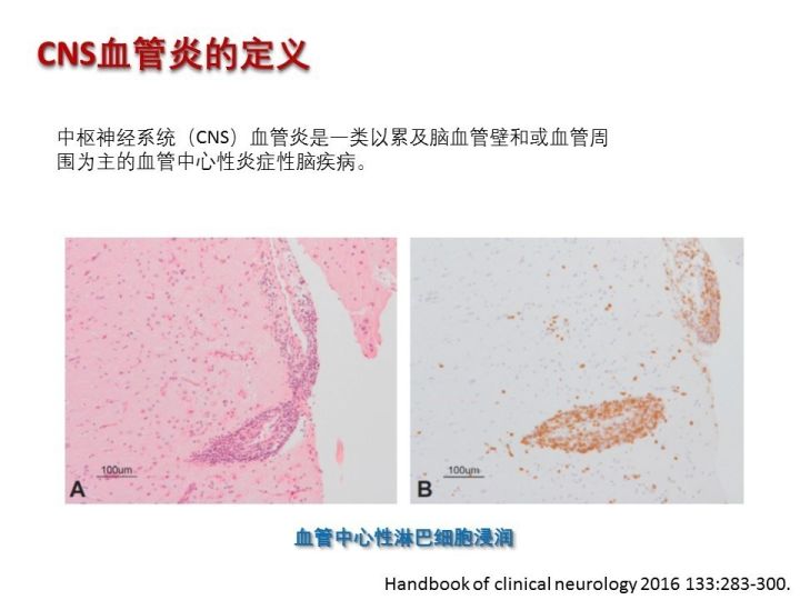 【PPT】中枢神经系统血管炎的临床思考