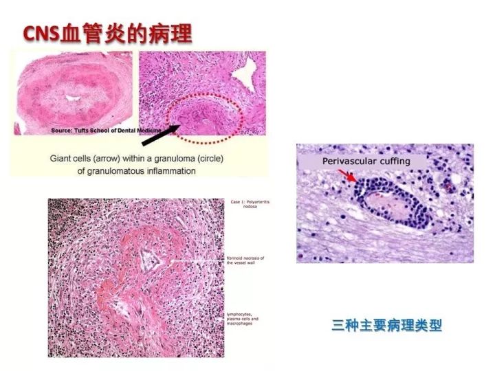 【PPT】中枢神经系统血管炎的临床思考