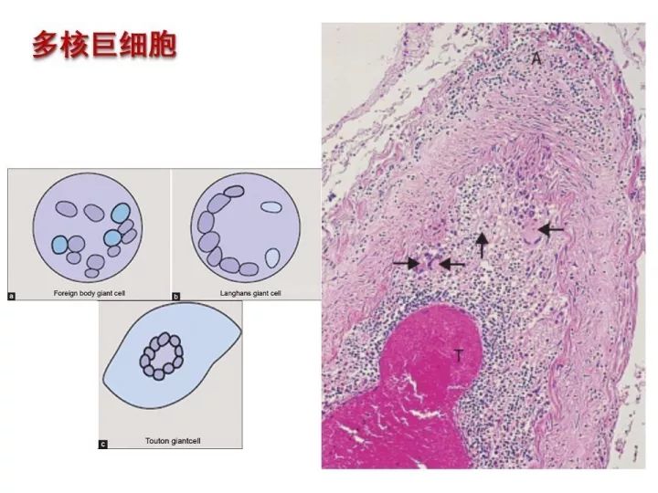 【PPT】中枢神经系统血管炎的临床思考