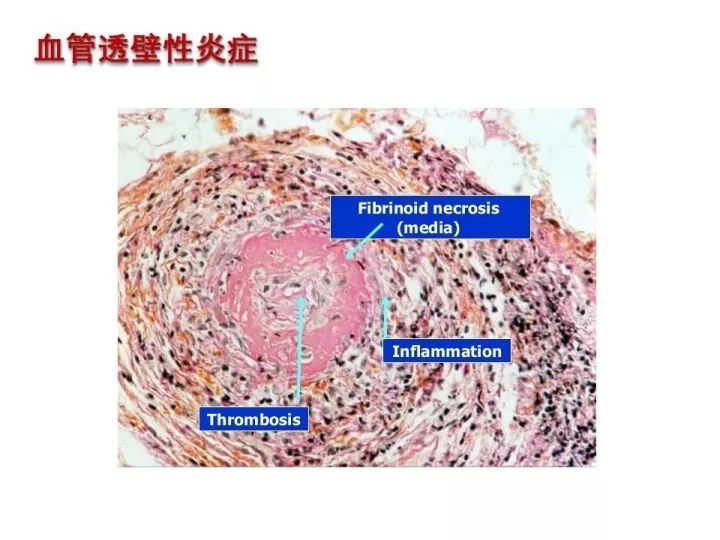 【PPT】中枢神经系统血管炎的临床思考