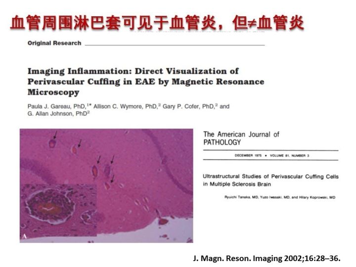 【PPT】中枢神经系统血管炎的临床思考