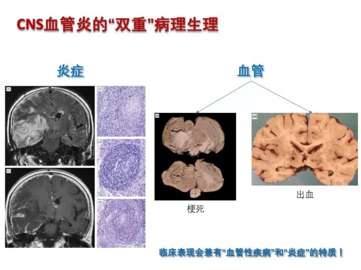 【PPT】中枢神经系统血管炎的临床思考