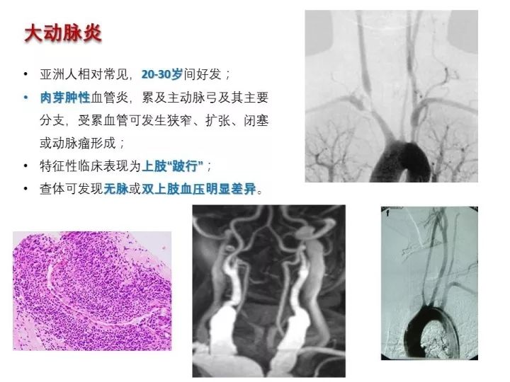 【PPT】中枢神经系统血管炎的临床思考
