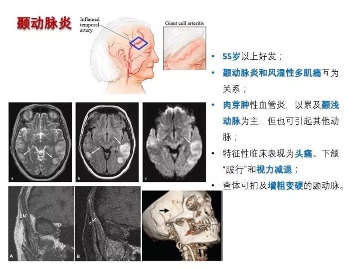 【PPT】中枢神经系统血管炎的临床思考