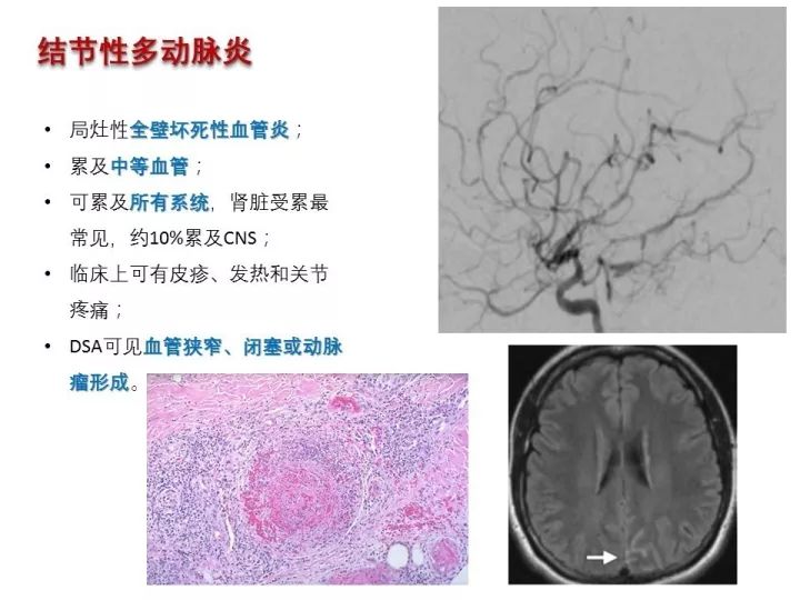 【PPT】中枢神经系统血管炎的临床思考