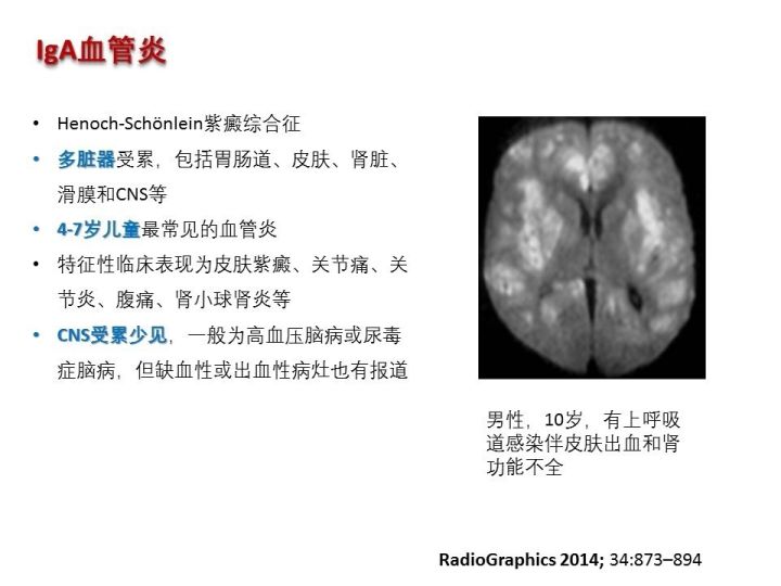 【PPT】中枢神经系统血管炎的临床思考