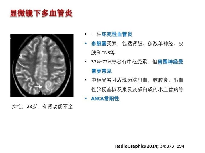 【PPT】中枢神经系统血管炎的临床思考