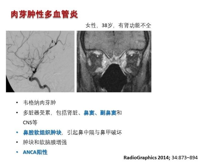 【PPT】中枢神经系统血管炎的临床思考